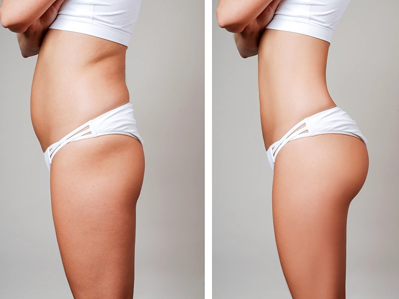 Vaser Liposuction What to