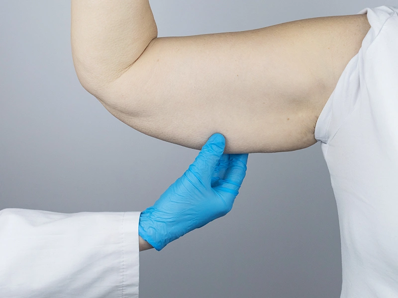Who May Be a Good Candidate for Arm Liposuction