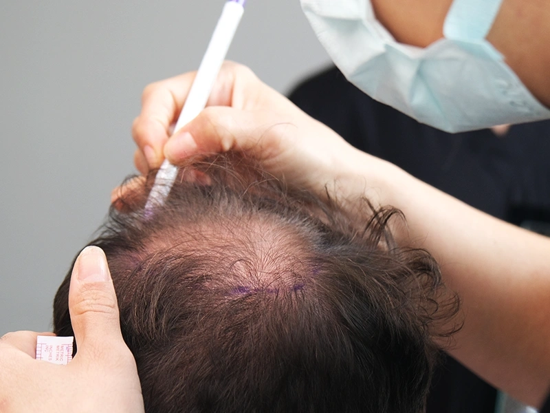 Who May Be a Good Candidate for Hair Transplantation