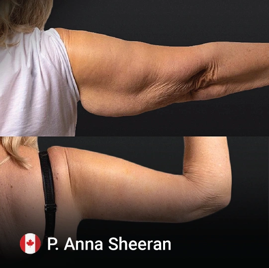 arm lift before and after 4