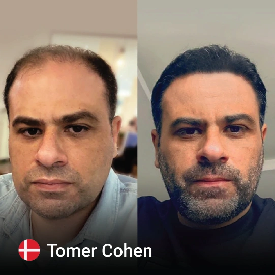 hair transplant before and after 3
