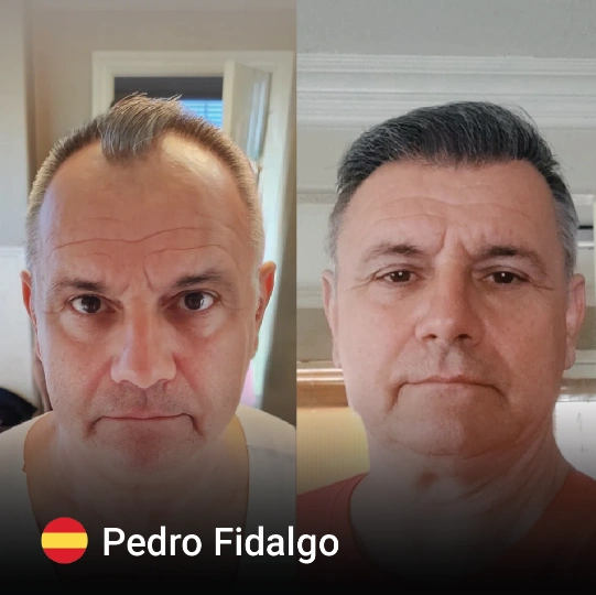 hair transplant before and after 5