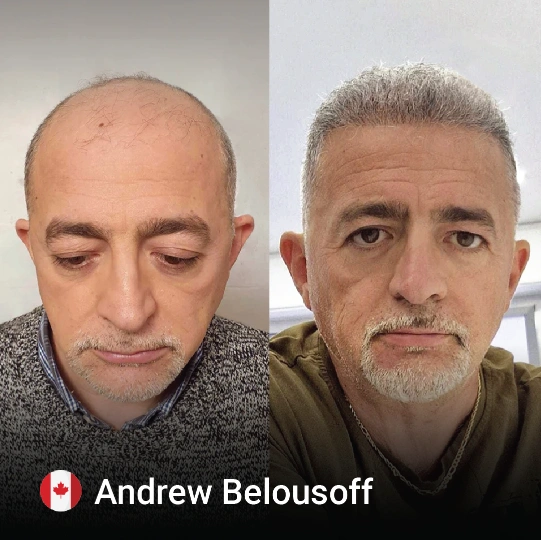 hair transplant before and after 7