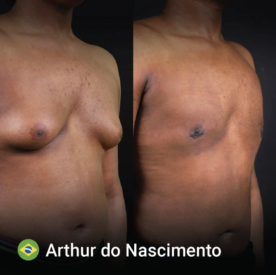 liposuction before and after 1 1
