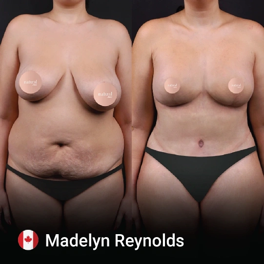liposuction before and after 5 1
