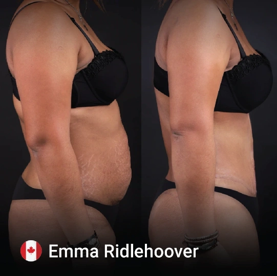 liposuction before and after 7 1