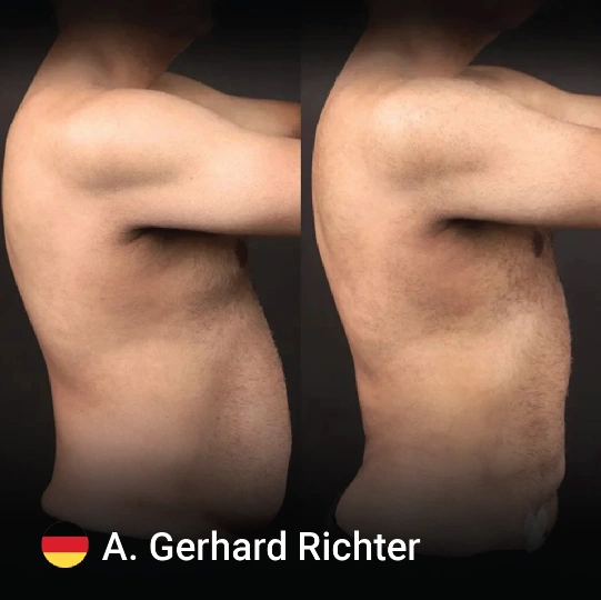 liposuction before and after 8 1
