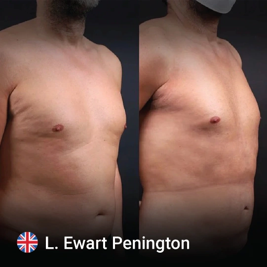 liposuction before and after 9 1