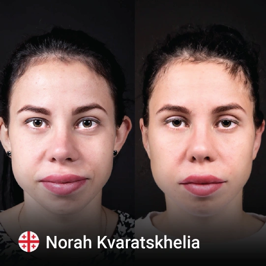 otoplasty before and after 4