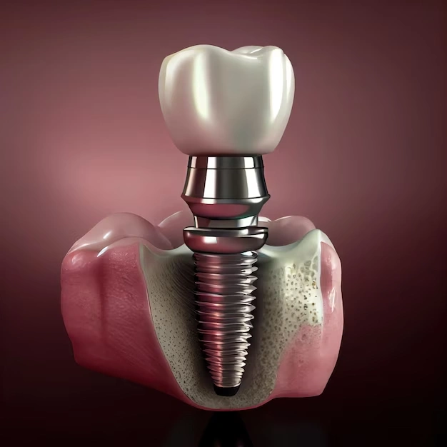illustration dental implant 257123 9928