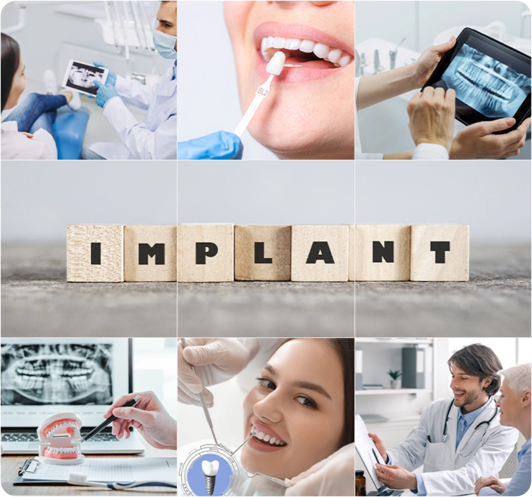 Dental Implant Gorsel 2