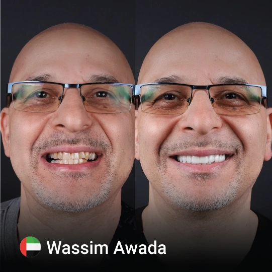 Hollywood smile before after 5 1