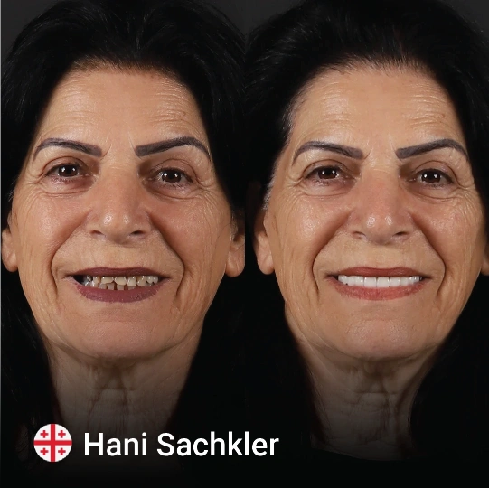 Hollywood smile before after 8 1