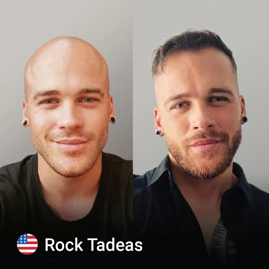 hair transplant before and after 1