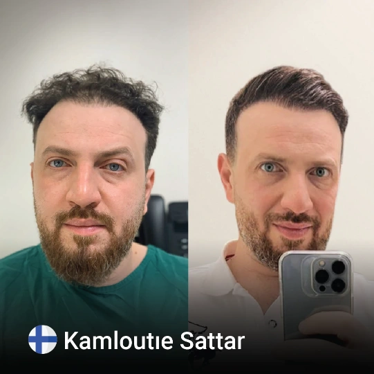 hair transplant before and after 4
