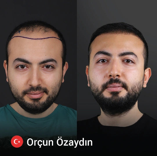 hair transplant before and after 8