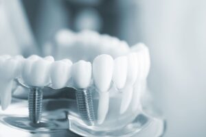 Image displaying how same day dental implants in Turkey could theoretically be placed inside the patient's gums and upper jawbone.