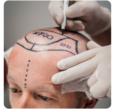 Hair transplant preparation stage at Natural Clinic, ensuring a seamless procedure with expert care