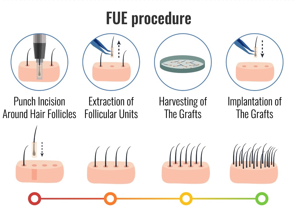 Fue Hair Transplant