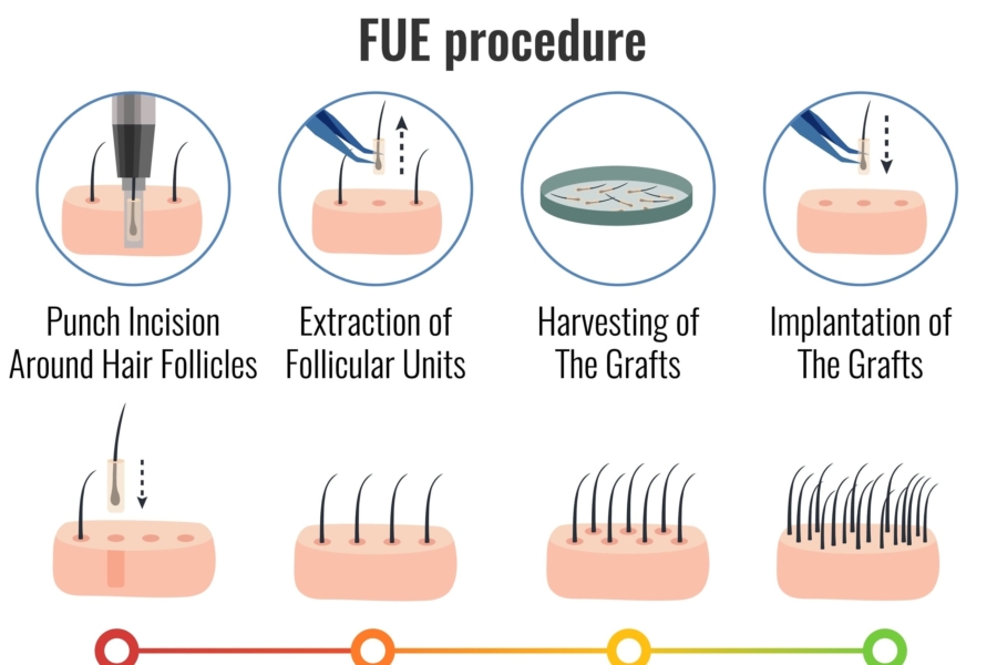 FUE Hair Transplant Turkey | The Best Hair Restoration Method