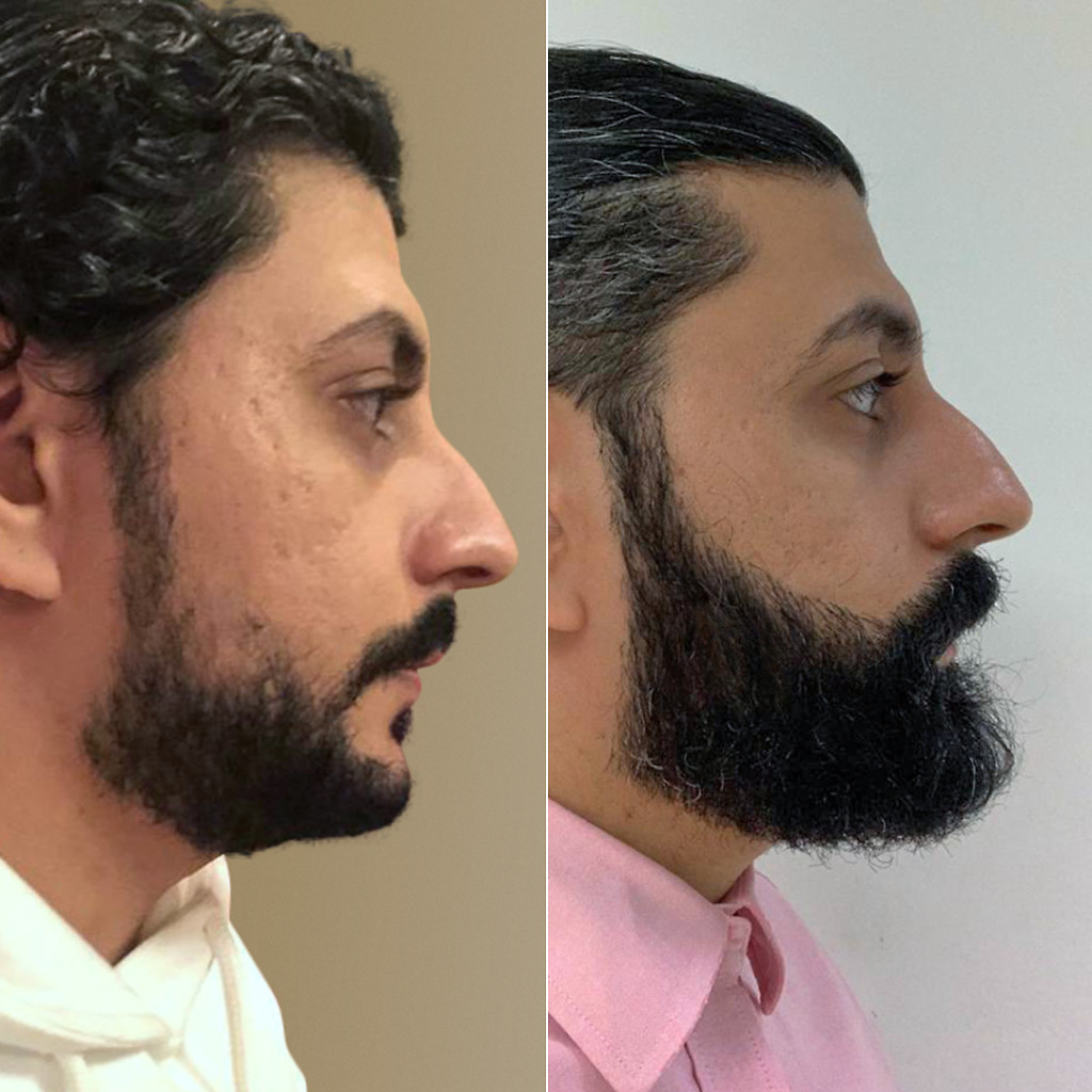 Side-by-side comparison of before and after beard transplantation at Natural Clinic, highlighting the transformation to a fuller, natural beard