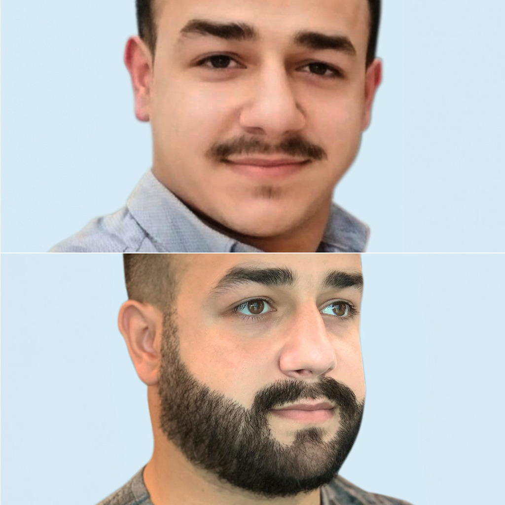 Before and after images of beard transplantation at Natural Clinic, showcasing a seamless transformation to a fuller, well-defined beard