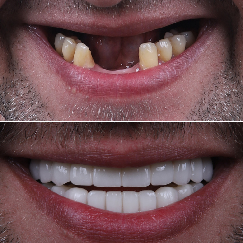 Smile design Turkey before and after photos showing successful dental transformations with improved aesthetics and functionality