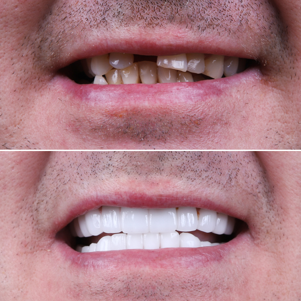 Natural Clinic's Hollywood Smile results before and after in Turkey, showcasing brighter, symmetrical teeth transformations