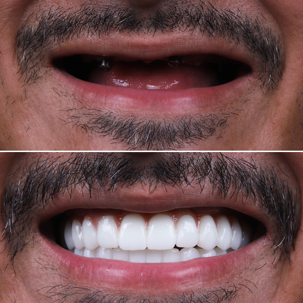 Hollywood Smile transformation in Turkey showcasing improved dental alignment and a sparkling white smile