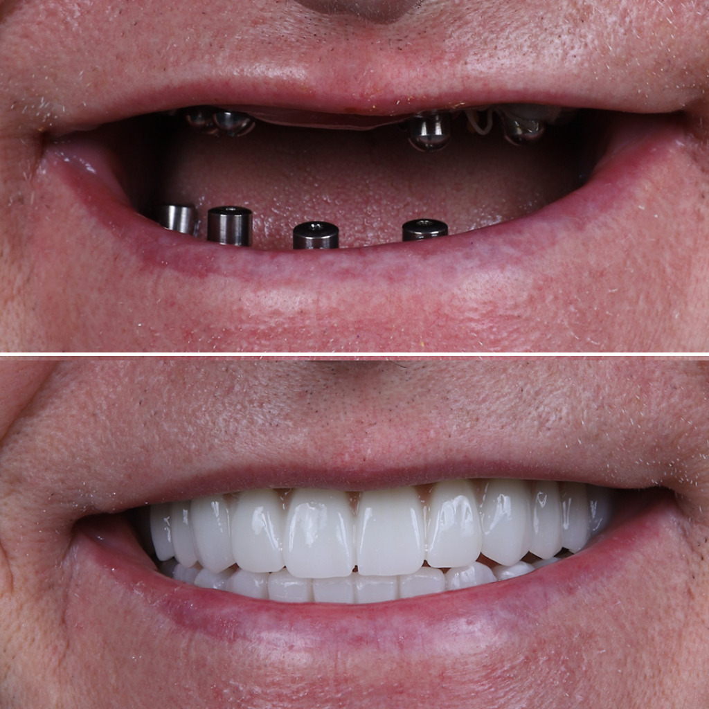 Before and after of Hollywood Smile at Natural Clinic Turkey.