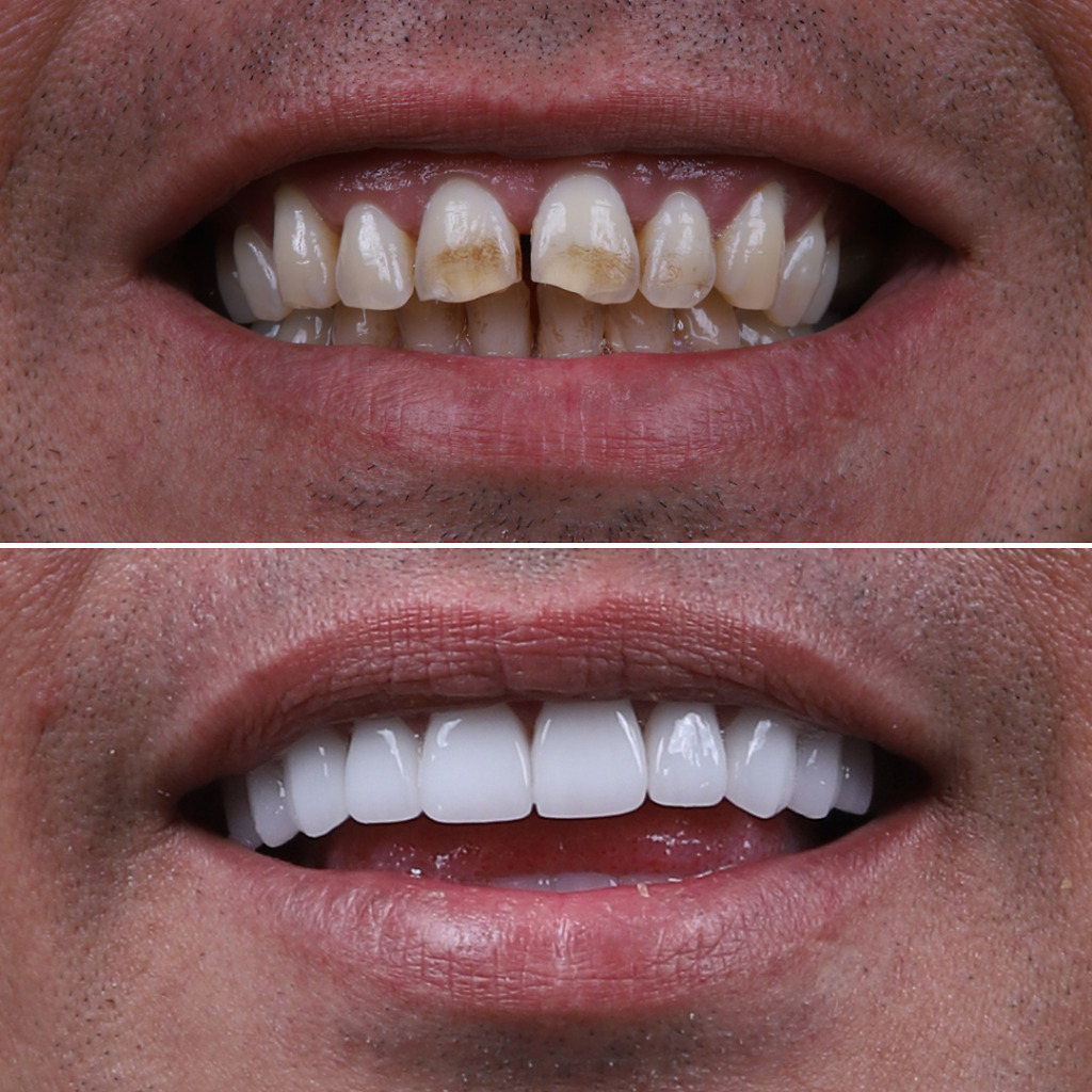 Hollywood Smile result with veneers at Natural Clinic Turkey