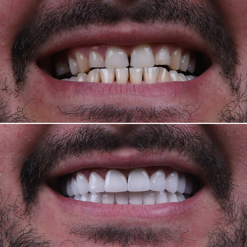 Before and after Hollywood Smile treatment by Natural Clinic Turkey