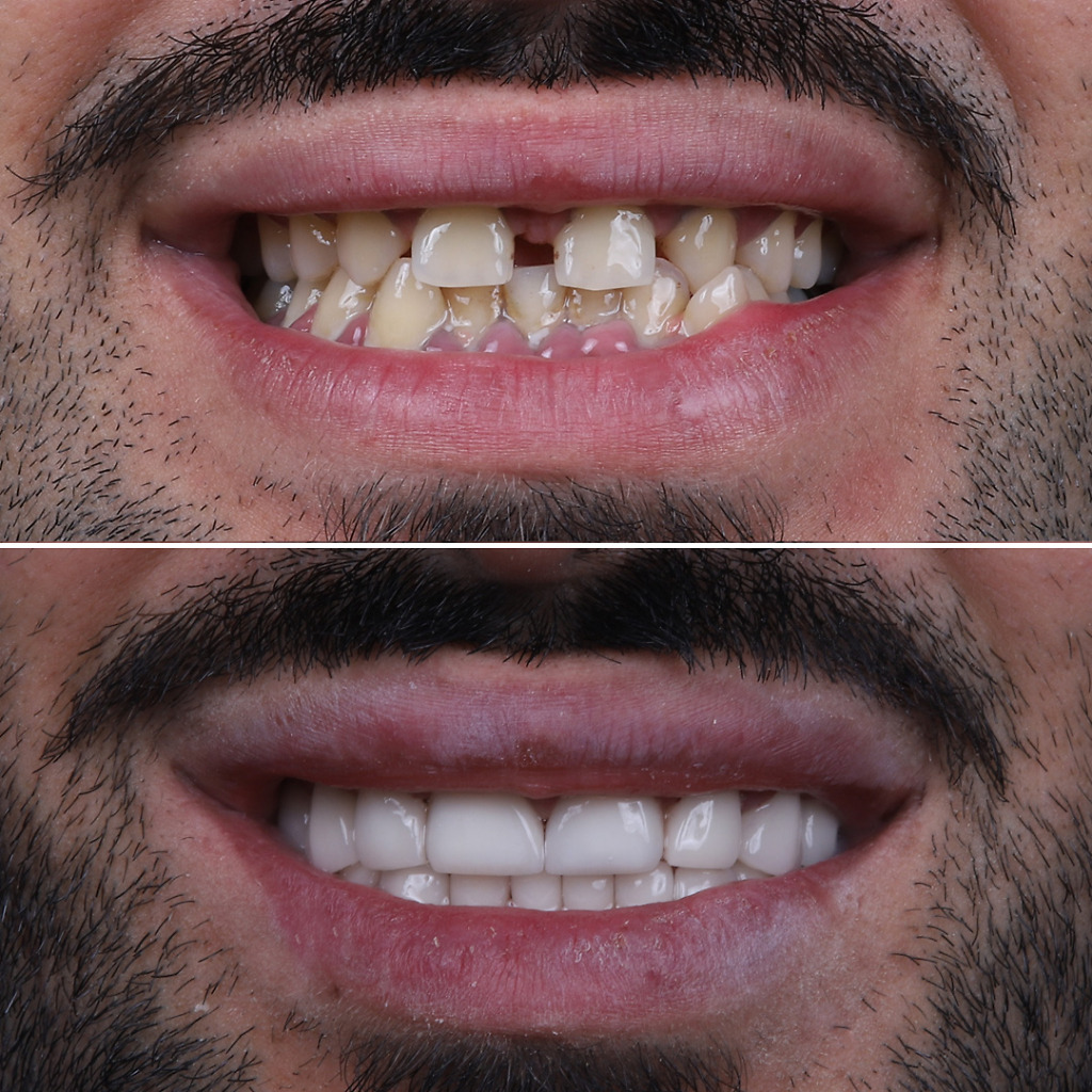 Natural Clinic's Hollywood Smile before and after photos demonstrating improved smile aesthetics in Turkey.