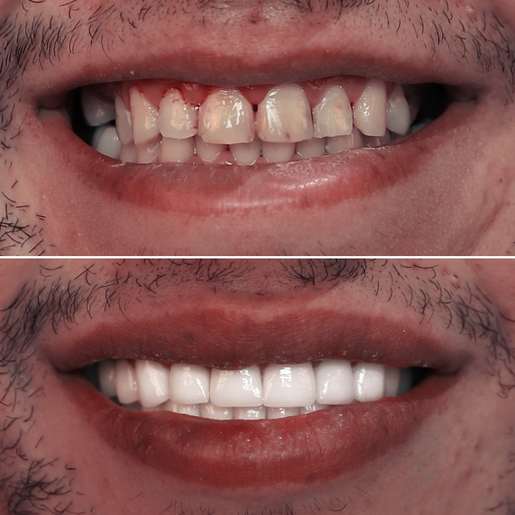 Patient's before and after Hollywood Smile makeover at Natural Clinic in Turkey