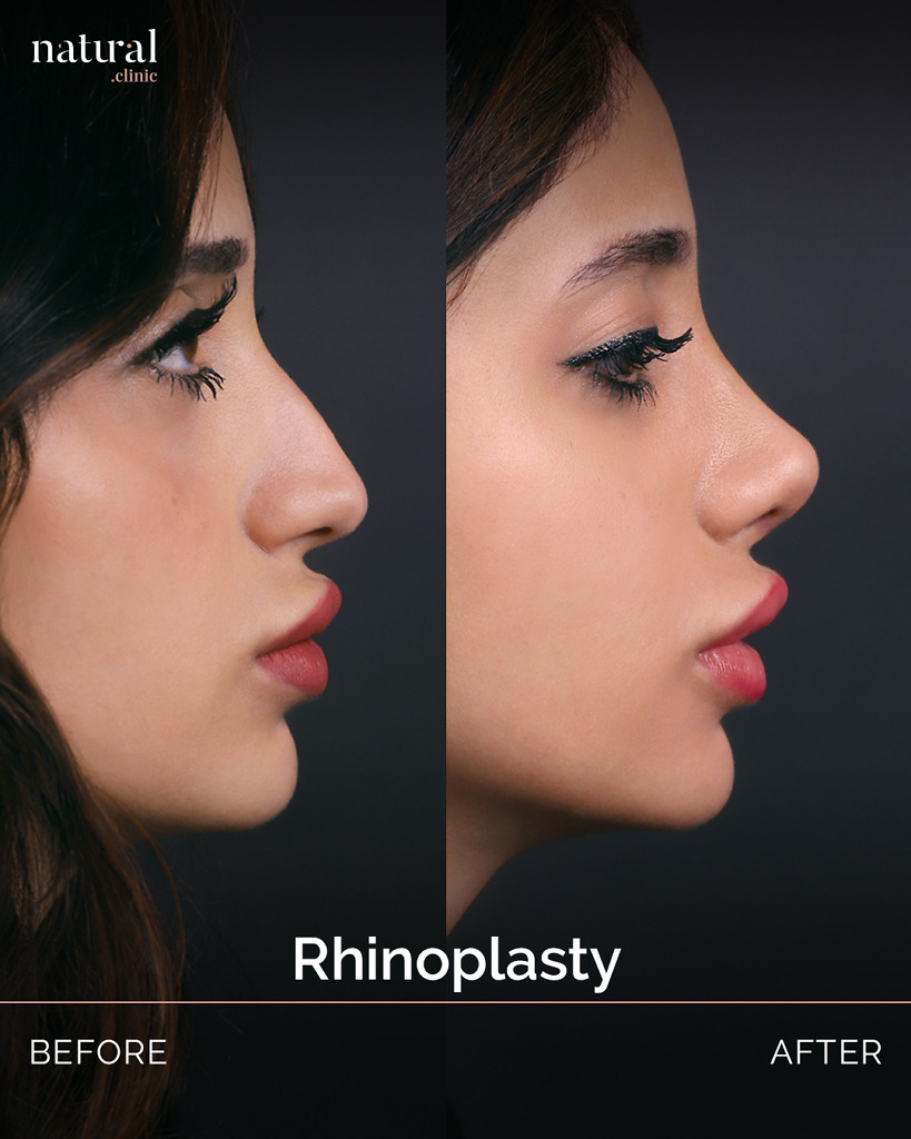 Rhinoplasty_33