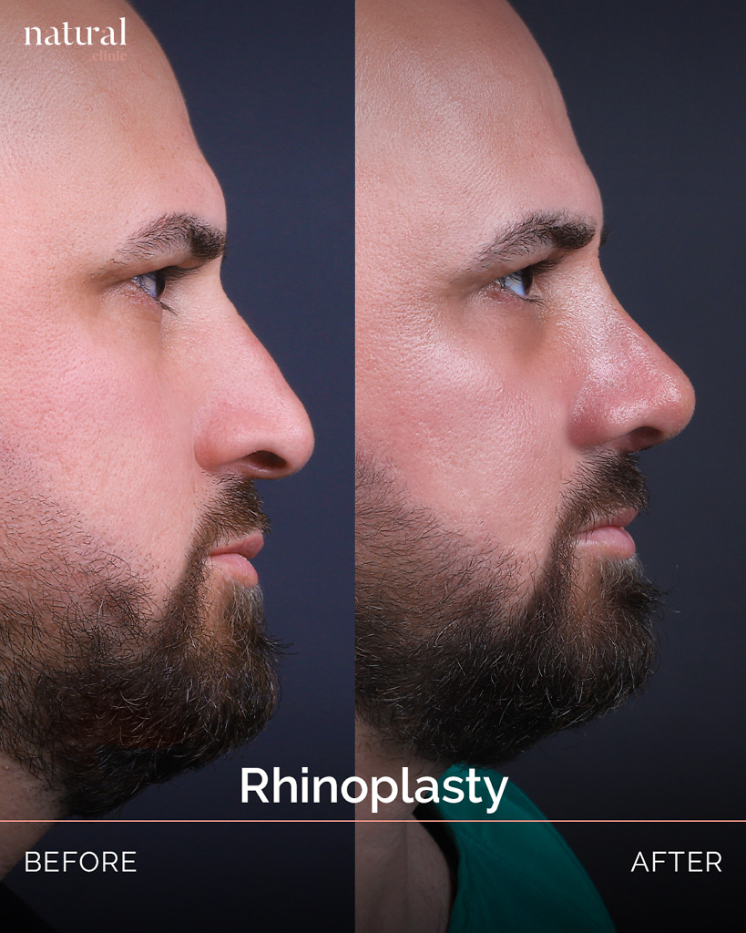 Rhinoplasty_34