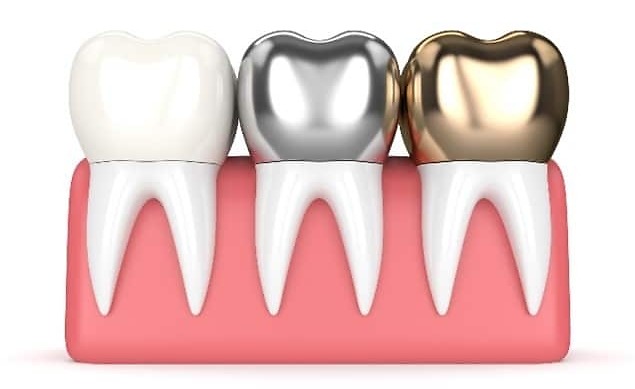 Illustration of dental crowns in porcelain, zirconium, and gold materials, showcasing their variety and durability