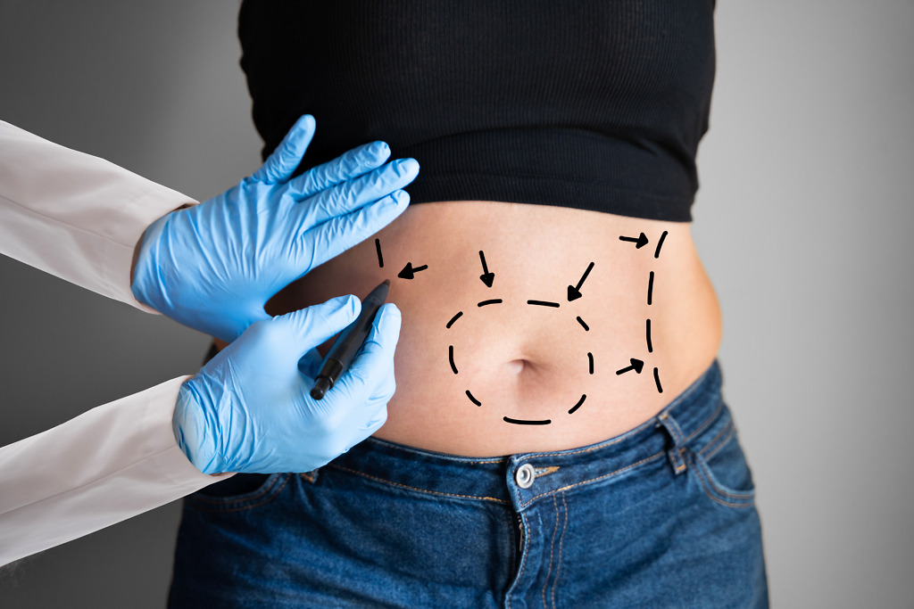 Doctor demonstrating VASER liposuction on marked abdomen, using ultrasound