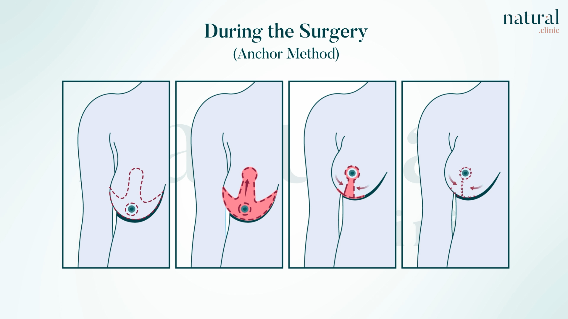 Anchor lift (inverted-T lift) infographic for Grade 3 severe breast sagging correction