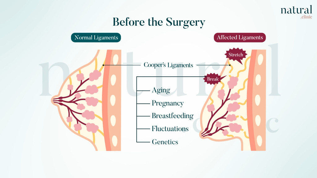 Illustration explaining causes of sagging breasts, including aging, weight loss, pregnancy, and genetics