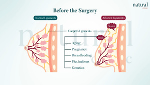 Illustration explaining causes of sagging breasts, including aging, weight loss, pregnancy, and genetics