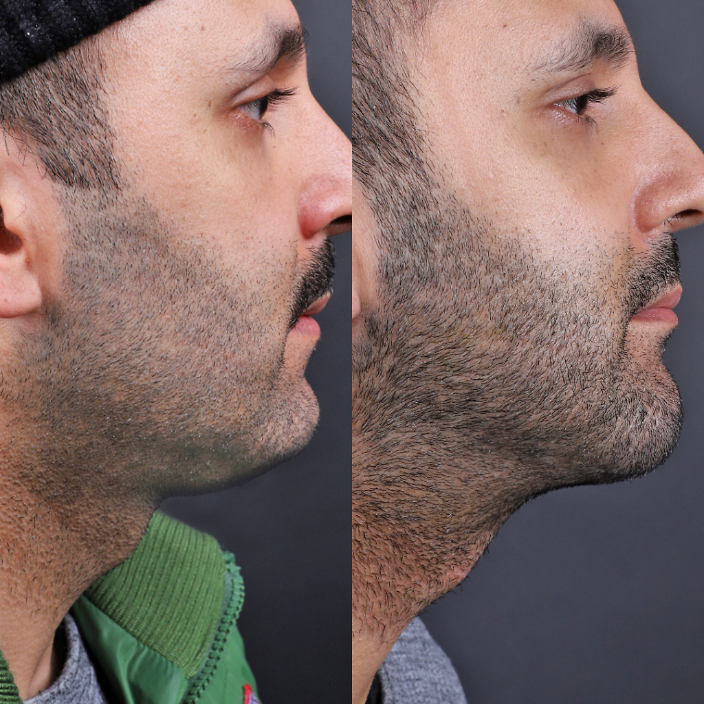 Chin liposuction results in Turkey: Before and after photos illustrating facial contour refinement