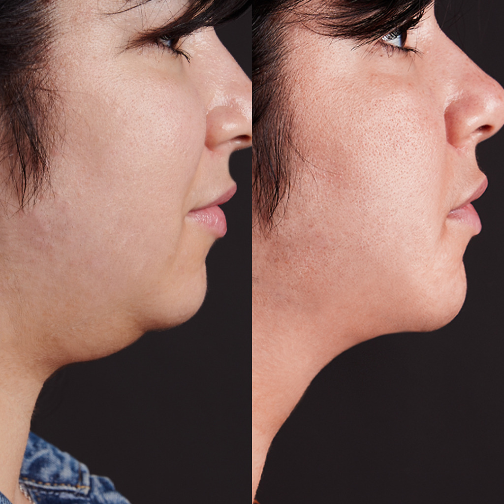 Before and after chin liposuction in Turkey, highlighting improved facial contours and profile