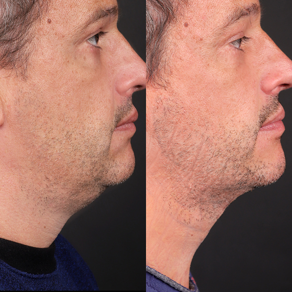 Transformation photos of chin liposuction patients in Turkey, showing visible improvement in chin and neck area