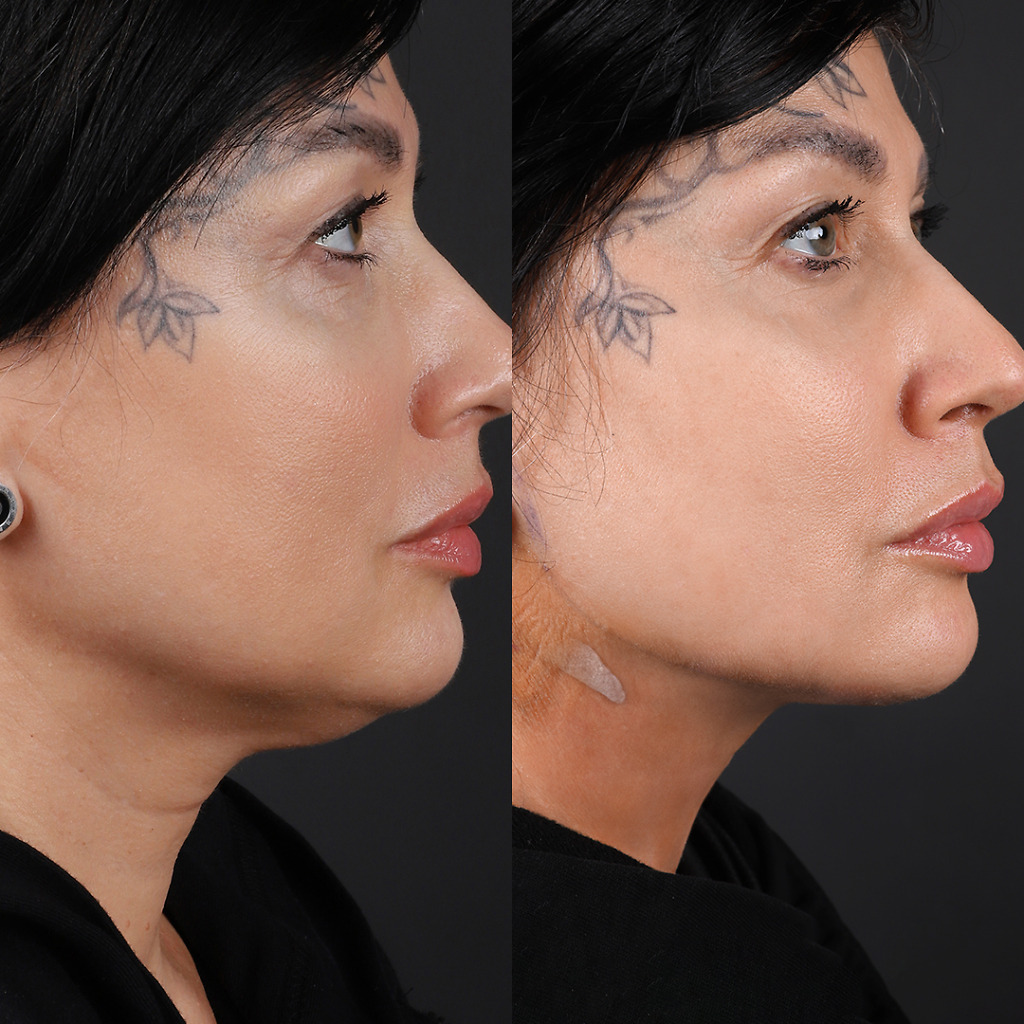 Before and after results of chin liposuction in Turkey, showcasing dramatic facial contour improvements