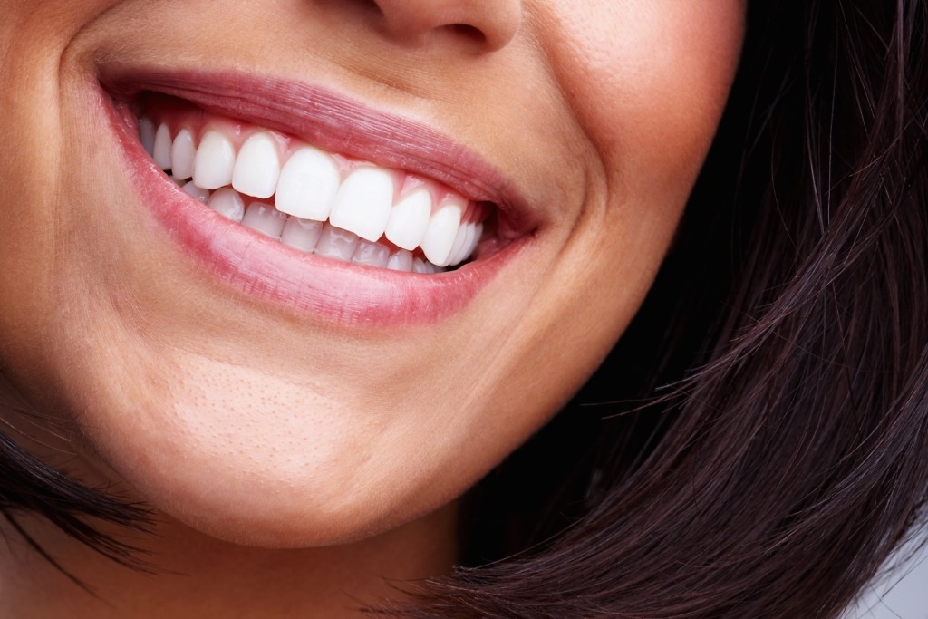 Close-up smile with porcelain veneers at Natural Clinic in Turkey