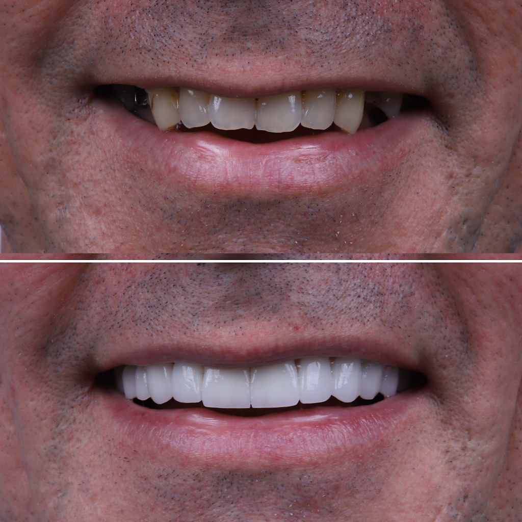 Dental veneers b&a 1