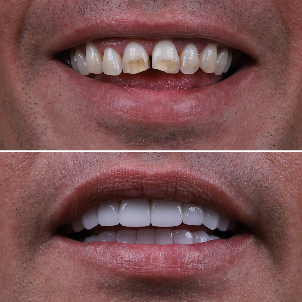 Dental veneers b&a 4