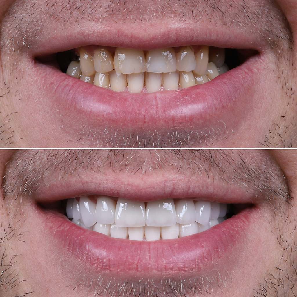 Dental veneers b&a 5