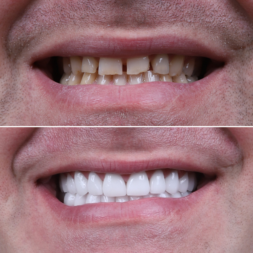 Dental veneers b&a 6